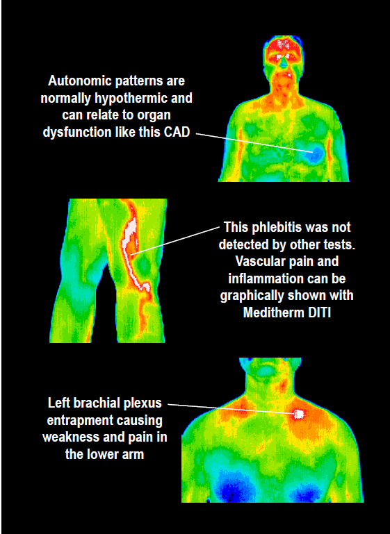 Thermography and Its Use in Cancer Treatment 2